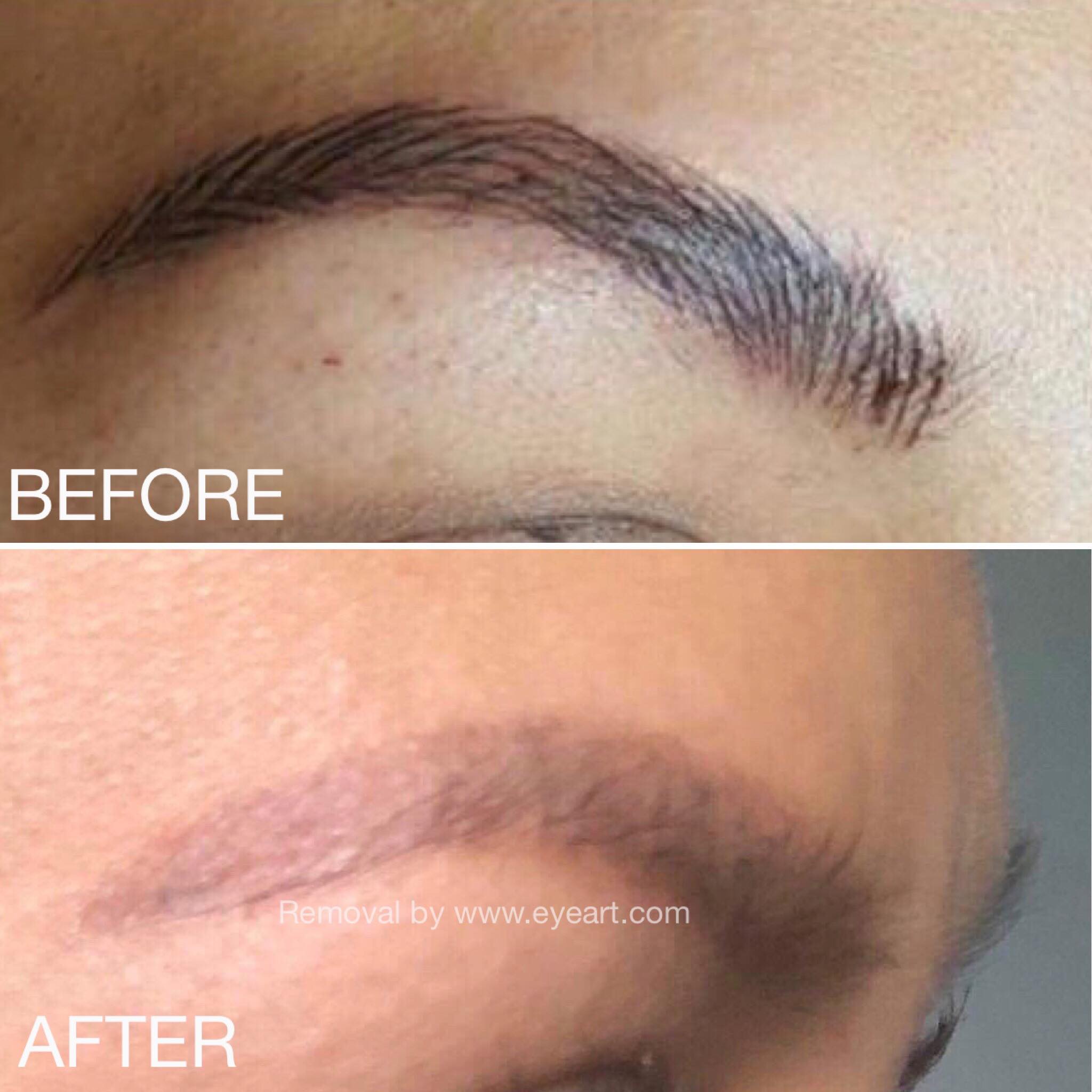 Eye Brow Tattoo Removal Before and After Photo by Eye Art Studio