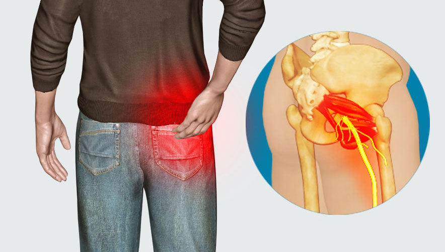 Allett Sciatica Nerve Damage Due to Wallet in Pocket