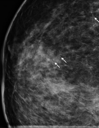 Moon and Lola - DCIS breast cancer x-ray