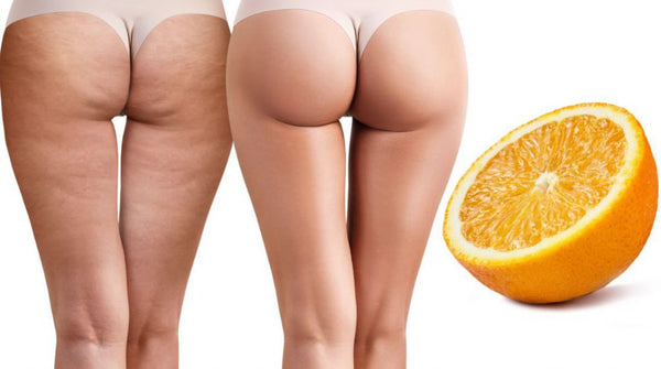 altimage:Cellulite