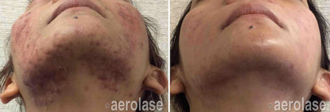 Before and after image of laser acne treatment of a lady