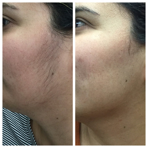 Before and after image of laser hair removal treatment on a women's face