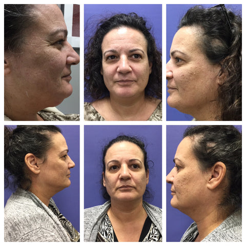All dimension face of lady after kybella treatment