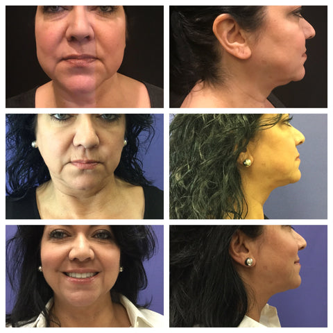 All dimension face of lady after kybella treatment