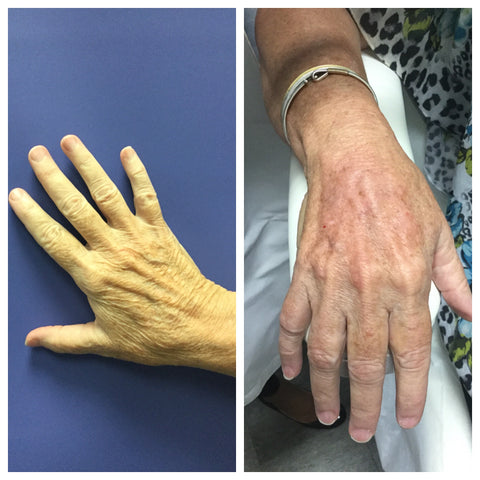 Before and after image of a women's hand 
