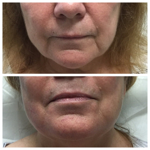 Before and after image of a lady with PDO threads treatment.
