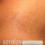 After laser vein removal treatment