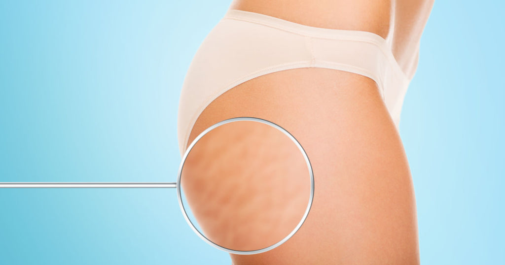 What Causes Cellulite