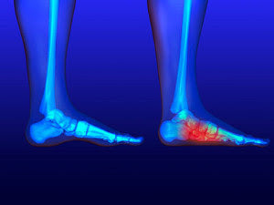 foot arch pain area