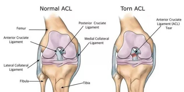What-Does-An-ACL-Injury-Look-Like