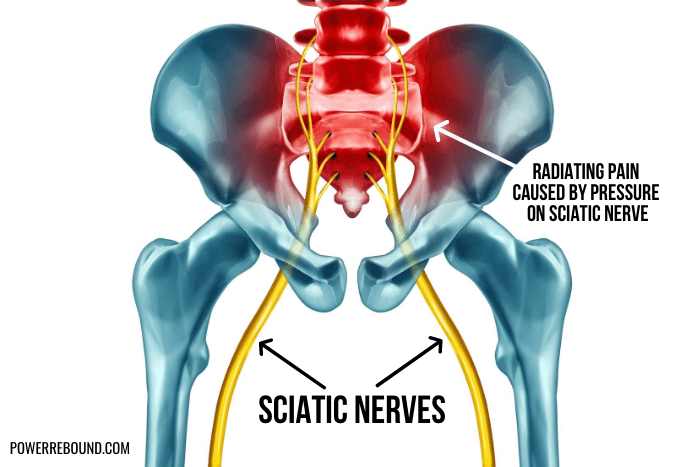 sciatic-nerves-and-radiating-pain