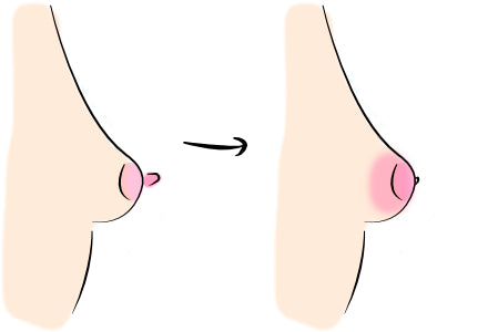 Mastitida zatuhnutí prsu
