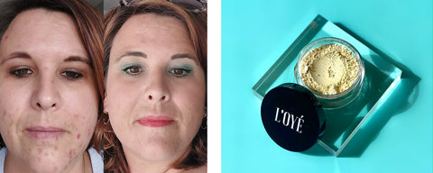 Robijn Grondig Pence Acne camoufleren met 100% minerale make-up – L'OYÉ Cosmetics
