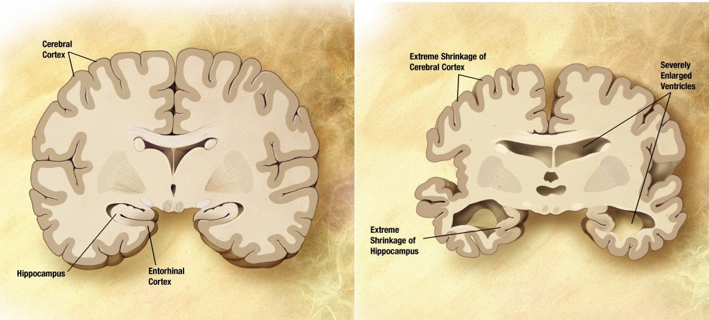 Green Tea and Alzheimer's disease