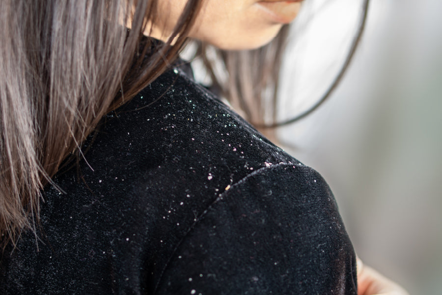 Hair Devils : Dandruff vs Dry Scalp