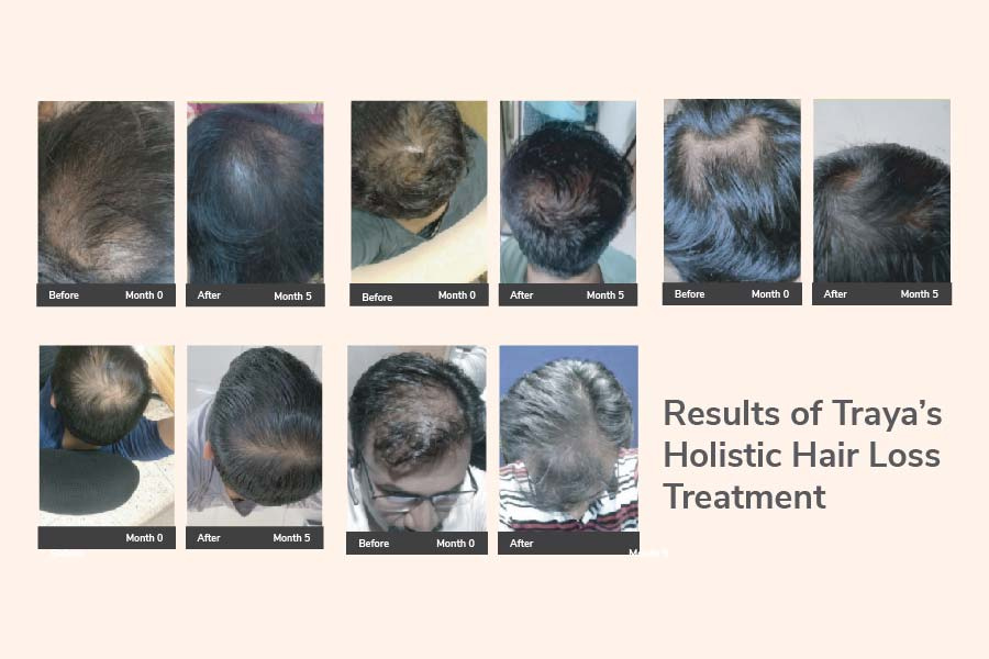 A case study of managing male pattern baldness with a holistic treatment