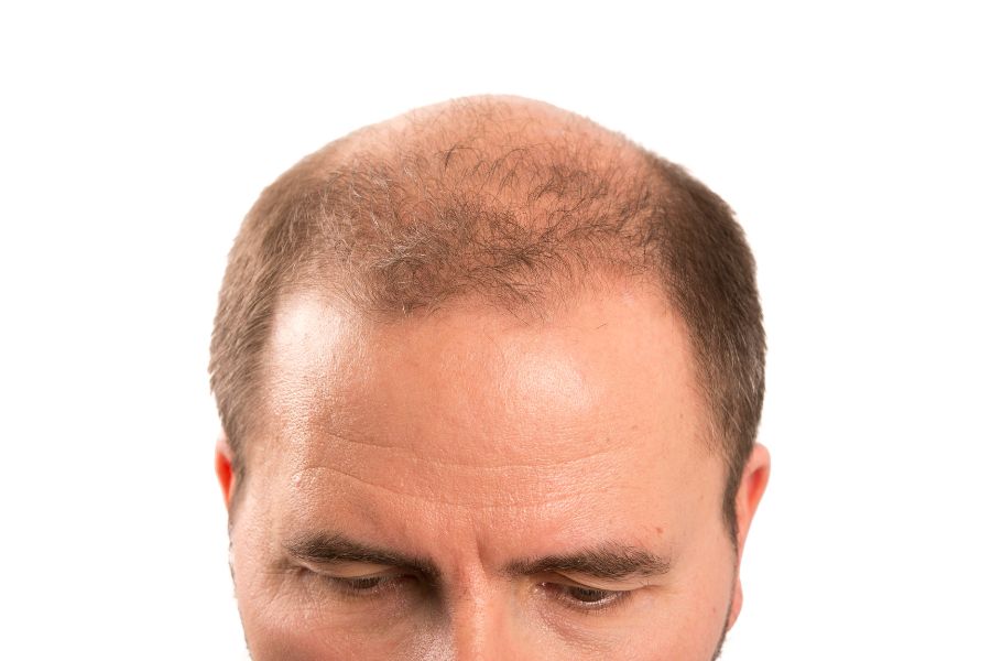 Baldness Gene: From Which Parent Baldness Is Inherited And It's Cure – Traya
