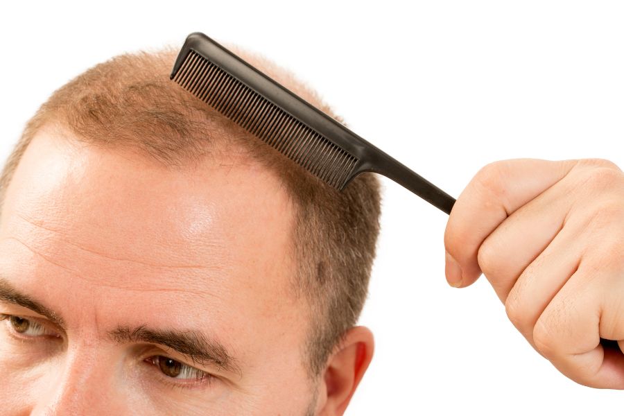 What Is The Reason Of Front Hair Thinning In Male – Traya