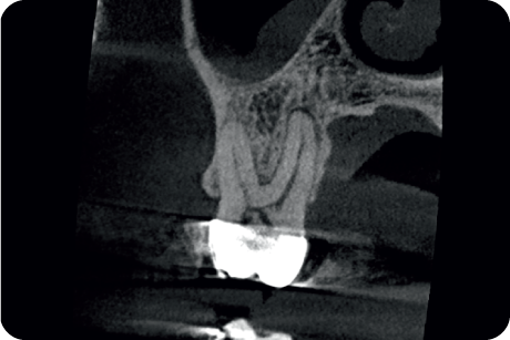 Diagnose endodontic pathosis