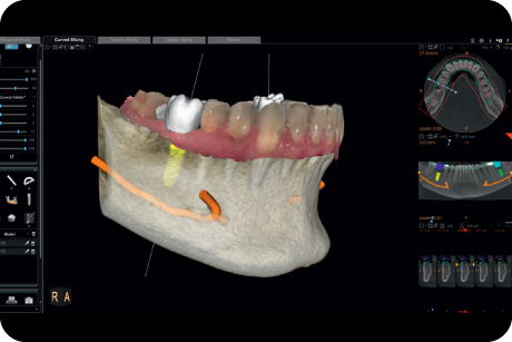 Plan implants using specialised 3D software