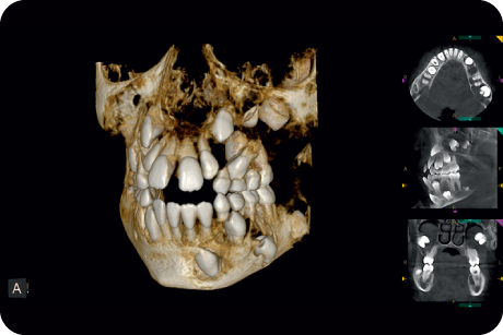 Define surgical protocol for impacted tooth extractions, cyst removals or periapical lesion treatments