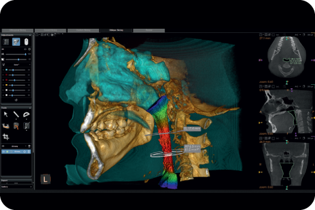 Analyse upper airway