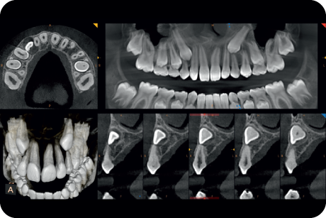 Evaluate ectopic and impacted teeth