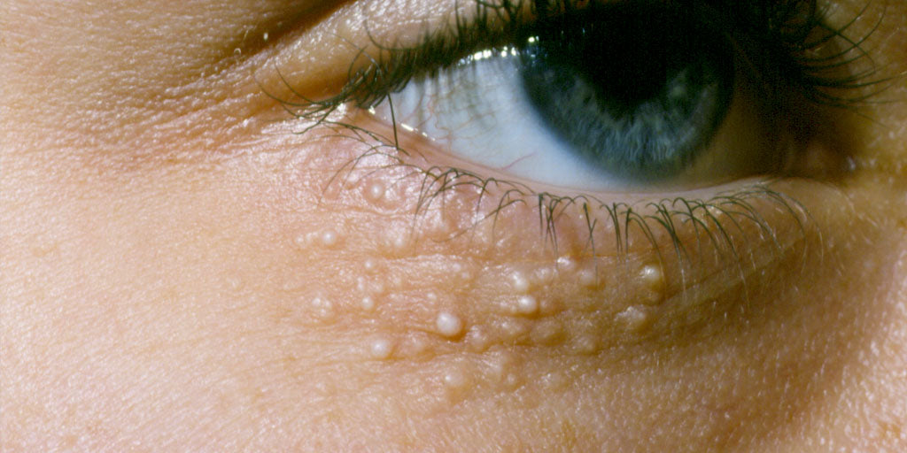 warts in the eyes