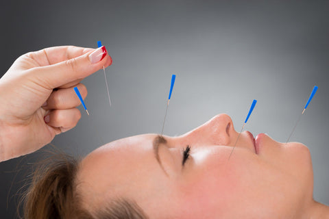 ShinLin Acupuncture needles for migraines and tension headaches from Lierre.ca Canada