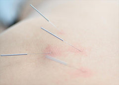 shop acupuncture needles at lierre 