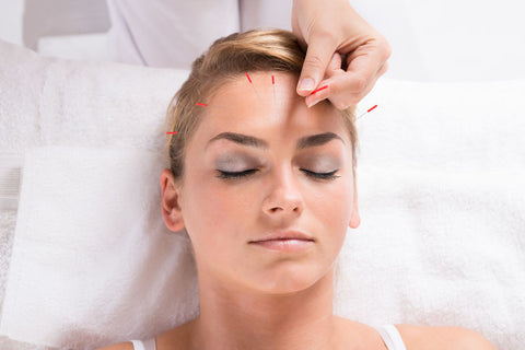 Acupuncture needles Relaxation Lierre Canada