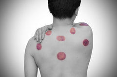 man after cupping treatment