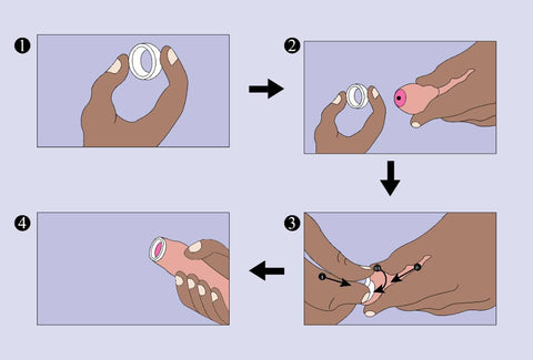 Curing phimosis