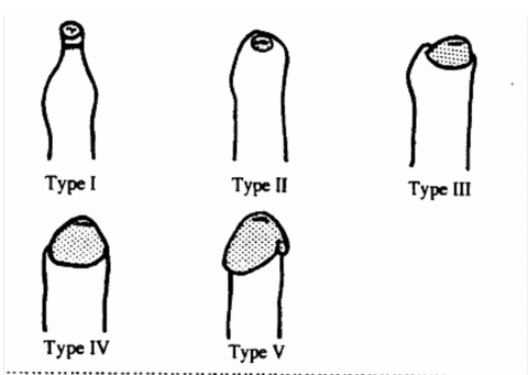 Phimosis stages - Kayaba classification