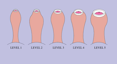 Phimosis Severity levels