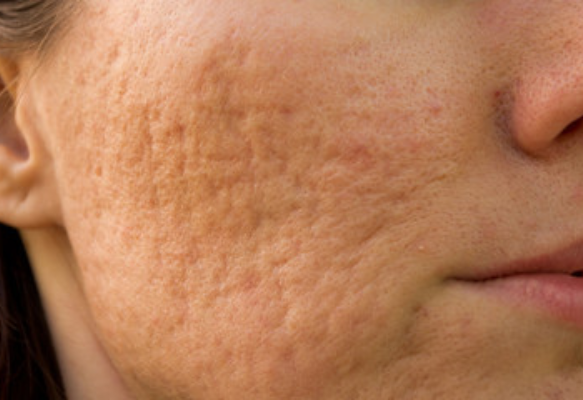 Image showing acne scarring