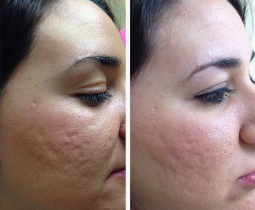Image showing before and after effects of microneedling
