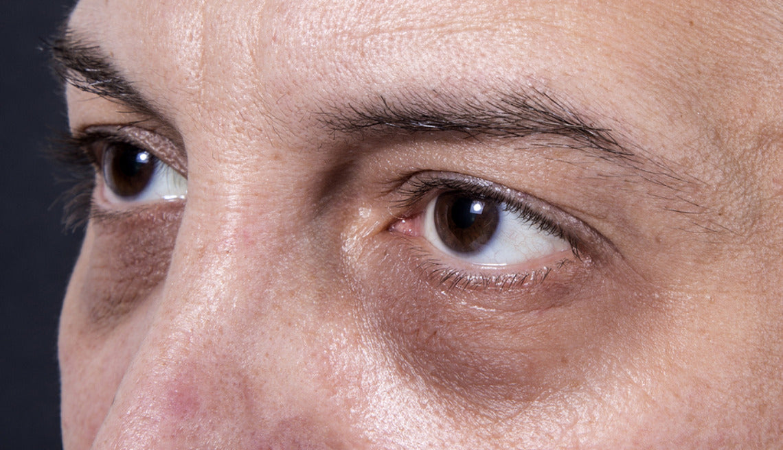 Image showing dark circles under the eye