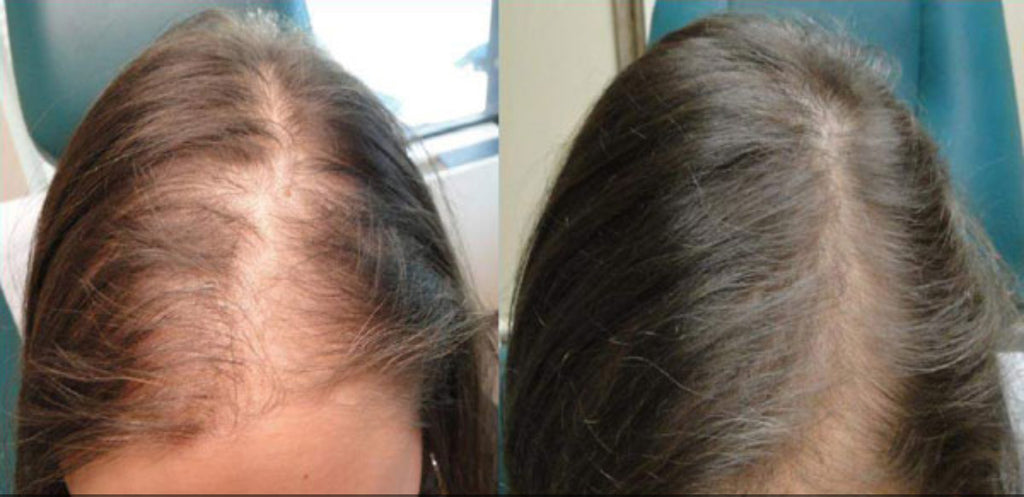 Before and after hair loss treatment