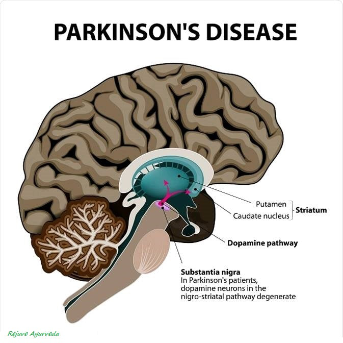 how parkinsons change the L DOPa in the brain... herbal supplements mucana or velvet bean helps
