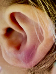 Ear Damage from not using Caulicure