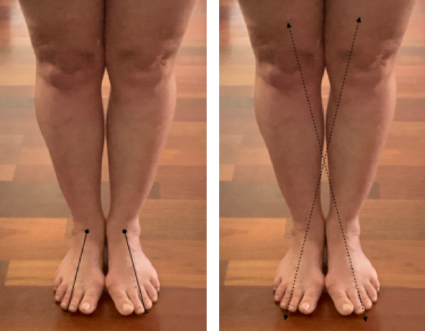 Feet together with bunions showing midlines of feet