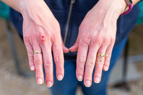 dry and cracked hands after overwashing