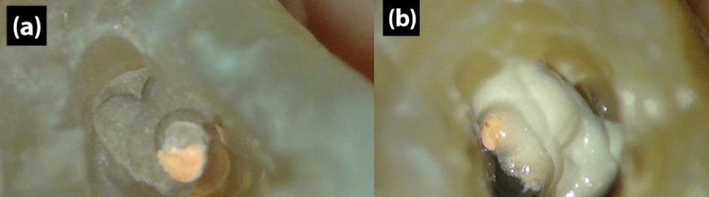 Materials were restored in artificial saliva. (a) Endocem MTA (b) Proroot MTA (c) Angelus MTA 