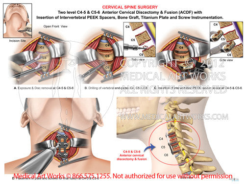 2 Level C4 5 And C5 6 Anterior Cervical Discectomy And Fusion Acdf Male — Medical Art Works 8350