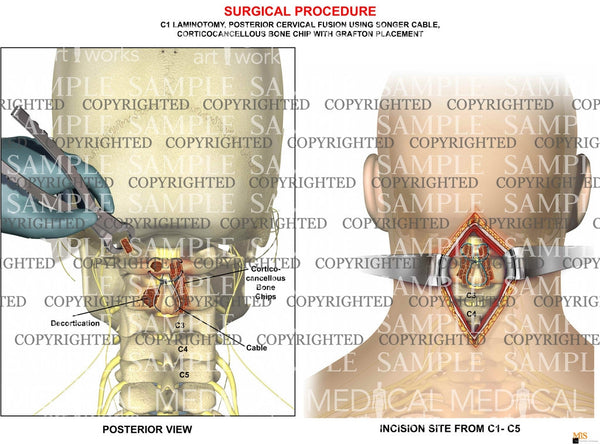 1 Level C1 C2 Posterior Cervical Fusion — Medical Art Works