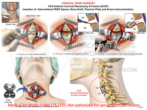 1 level C56 Anterior cervical discectomy and fusion