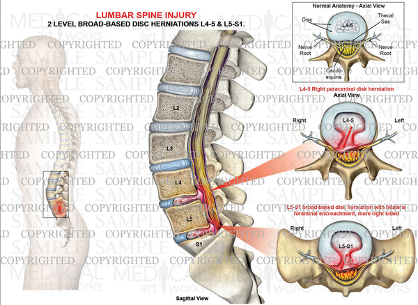 2 Level L45, L5S1 lumbar disc herniations — Medical