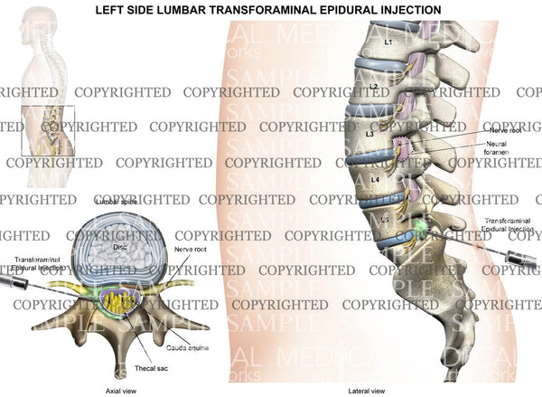 lumbar l5 s1