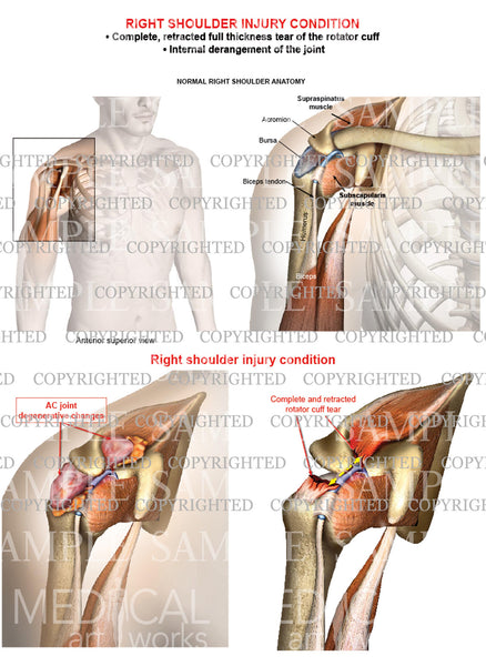 Right shoulder rotator cuff complete retracted tear - Internal